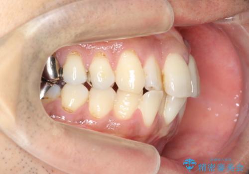 [マウスピース矯正]インビザラインによる前歯のガタつき改善の治療前