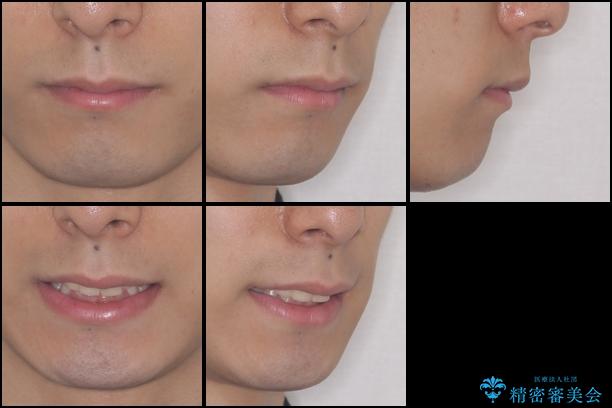 インビザライン・ライトによる、軽度な歯列不正の解消の治療前（顔貌）