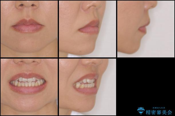 インビザラインによるオープンバイト治療　顎の負担も軽減の治療前（顔貌）