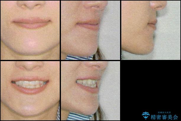 切端咬合の抜歯矯正　目立ちにくいワイヤー矯正の治療前（顔貌）