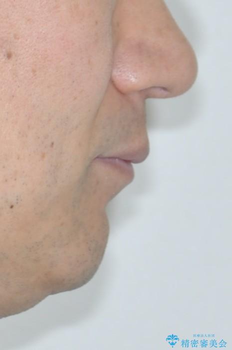 ワイヤー矯正による出っ歯の治療　表の審美装置で見た目と機能性を両立の治療前（顔貌）