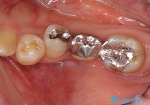小矯正を併用し機能性・清掃性を高めた臼歯部ブリッジ治療の治療前
