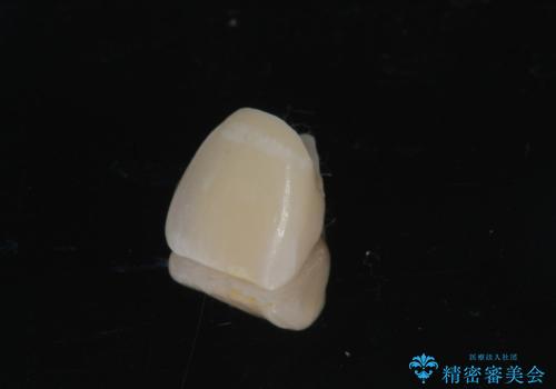 [ 前歯 審美回復 ] 治療途中からの転院　天然歯を模したセラミッククラウン