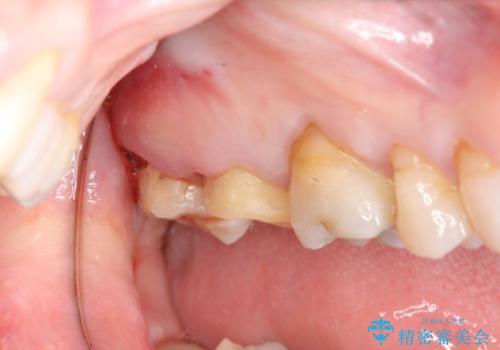 [骨縁に達する深い虫歯] 歯の挺出・歯周外科を応用し抜かずに残す治療①の治療後