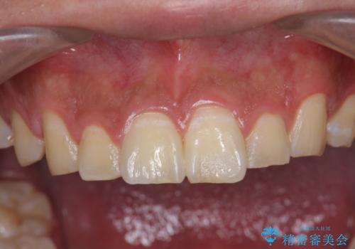 [ 前歯 審美回復 ] 治療途中からの転院　天然歯を模したセラミッククラウンの治療後