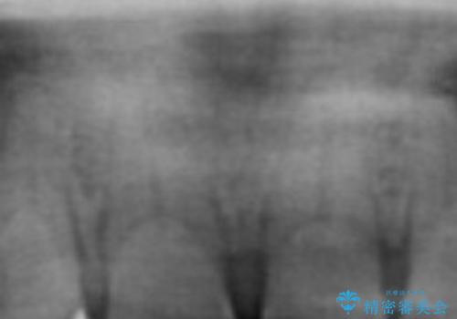 上の両前歯が欠けて年々短くなる　セラミック審美治療の治療前