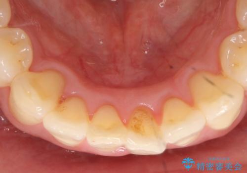 [マウスピース矯正]インビザラインによる前歯のガタつき改善の治療中