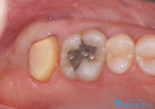 [骨縁に達する深い虫歯] 歯の挺出・歯周外科を応用し抜かずに残す治療②の治療中