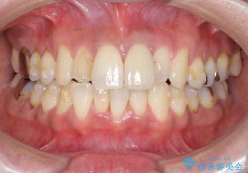 [マウスピース矯正]インビザラインによる前歯のガタつき改善の治療中