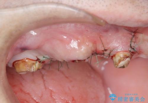 [ 重度虫歯治療 ]　ブリッジ・インプラントによる咬合・審美回復①の治療後