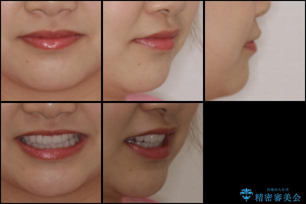 前歯のでこぼこと咬み合わせの改善　インビザラインでのスピード矯正の治療後（顔貌）
