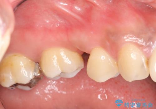 放置した歯の欠損　ブリッジによるスピーディーな咬合機能回復の治療前