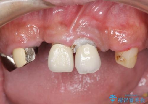 [ 重度虫歯治療 ]　ブリッジ・インプラントによる咬合・審美回復②の治療前