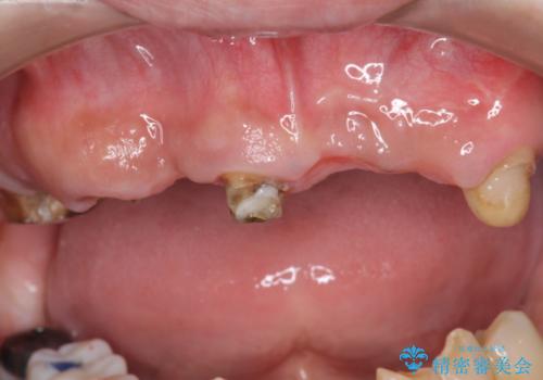 [ 重度虫歯治療 ]　ブリッジ・インプラントによる咬合・審美回復①の治療中