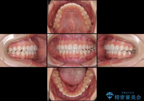 前歯のでこぼこと咬み合わせの改善　インビザラインでのスピード矯正の治療中