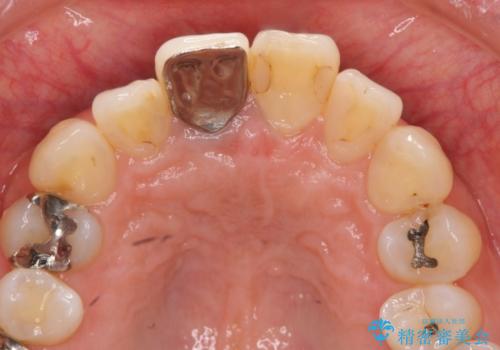 前歯の色を揃えたい　上顎前歯オールセラミックジルコニアクラウン治療の治療前