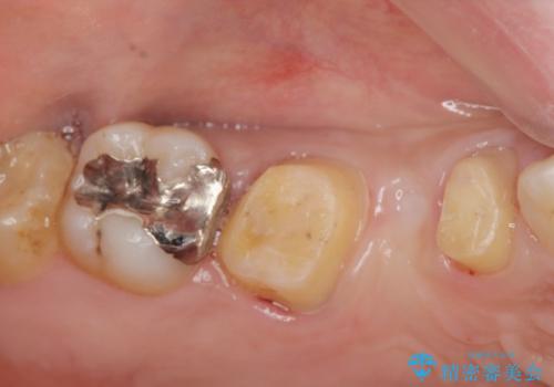放置した歯の欠損　ブリッジによるスピーディーな咬合機能回復の治療中