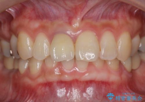 前歯の色を揃えたい　上顎前歯オールセラミックジルコニアクラウン治療の治療後