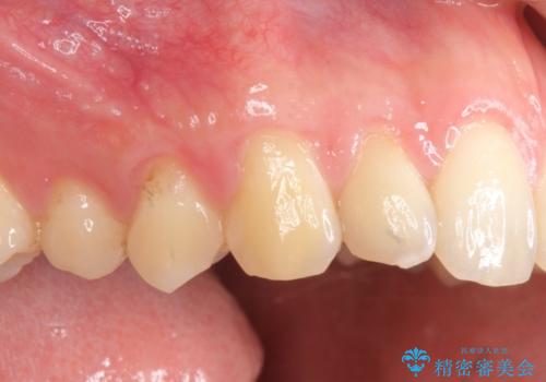 歯ぐきの下がりが気になる　歯肉移植による改善の治療後