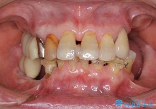 [入れ歯を外したい]  全顎的インプラント・補綴治療の治療中