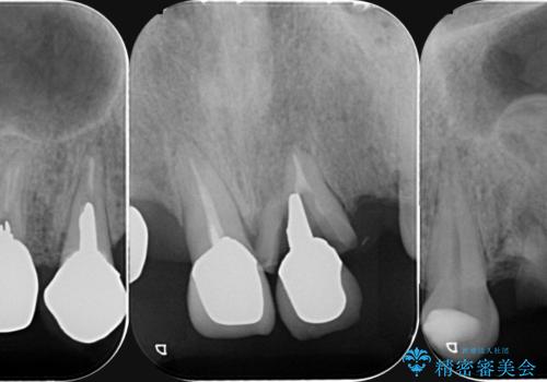 [ 重度虫歯治療 ]　ブリッジ・インプラントによる咬合・審美回復①の治療前