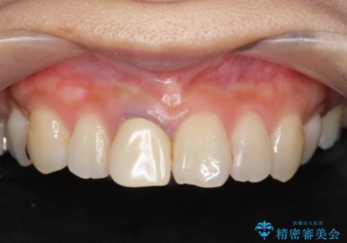 前歯の色を揃えたい　上顎前歯オールセラミックジルコニアクラウン治療の治療前