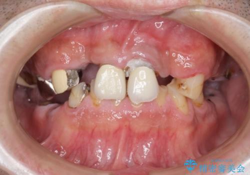 [ 重度虫歯治療 ]　ブリッジ・インプラントによる咬合・審美回復②の治療前