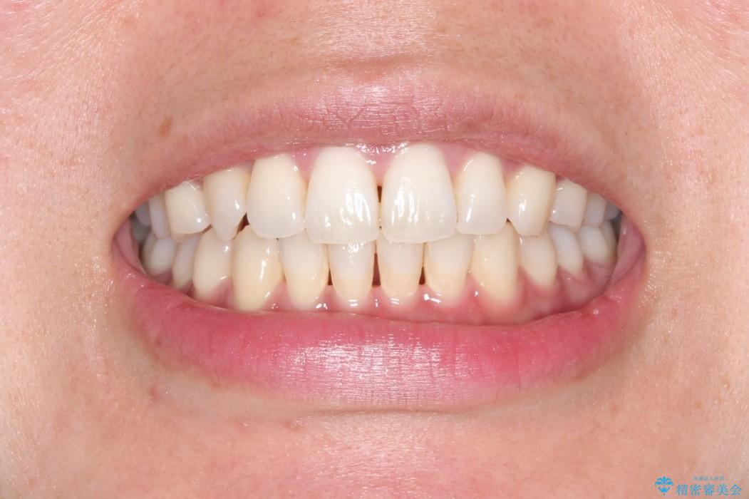 前歯のクロスバイトをインビザラインとマイクロインプラントのコンビネーションで短期間に治すの治療後（顔貌）