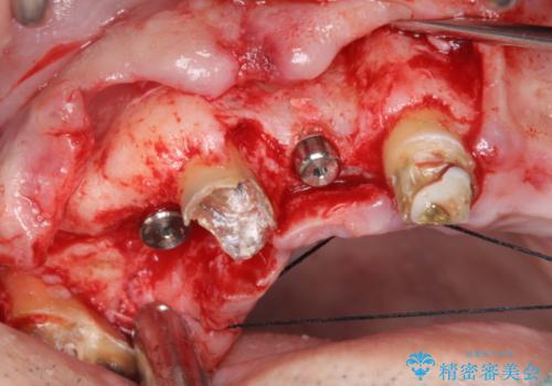 [ 重度虫歯治療 ]　ブリッジ・インプラントによる咬合・審美回復①の治療中
