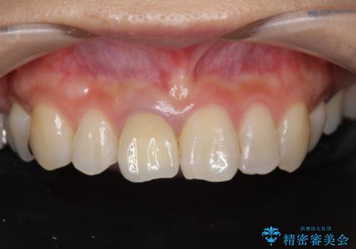 前歯の色を揃えたい　上顎前歯オールセラミックジルコニアクラウン治療の治療後