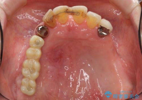 [入れ歯を外したい]  全顎的インプラント・補綴治療の治療中