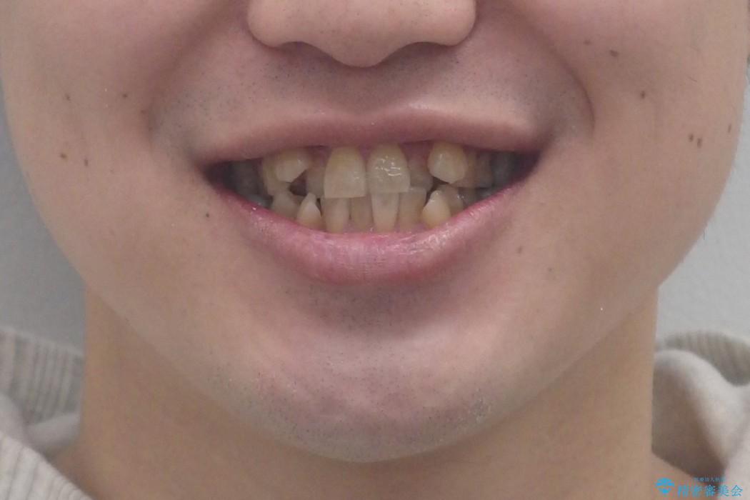八重歯　インビザラインで治したい　20代男性の治療前（顔貌）