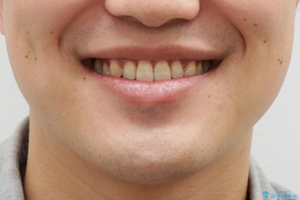 八重歯　インビザラインで治したい　20代男性の治療後（顔貌）
