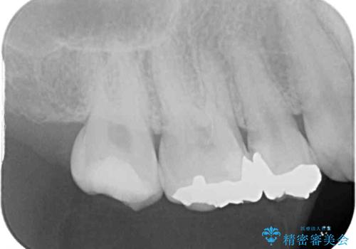 奥歯の銀歯をセラミックで白い歯にの治療前