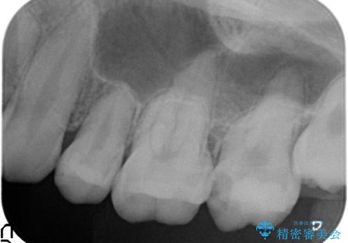 奥歯で広がった虫歯、中途半端な仮詰め状態をセラミッククラウンで解消するの治療前