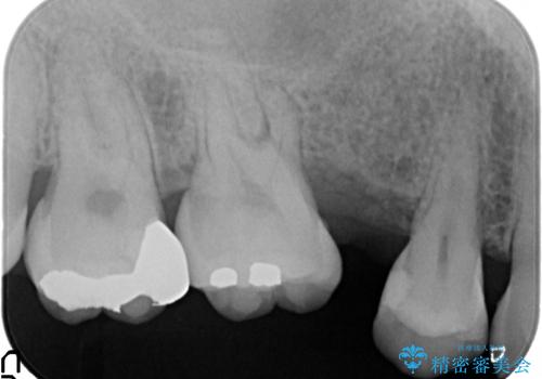 放置した歯の欠損　ブリッジによるスピーディーな咬合機能回復の治療前