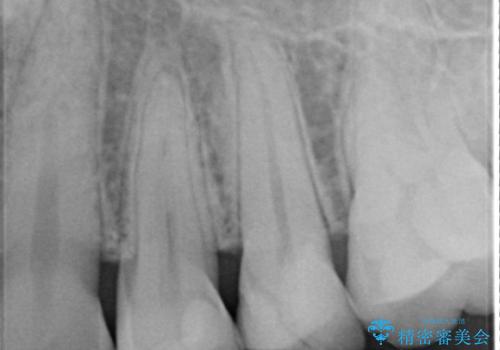 歯と歯の間の虫歯をセラミックインレーで修復の治療後