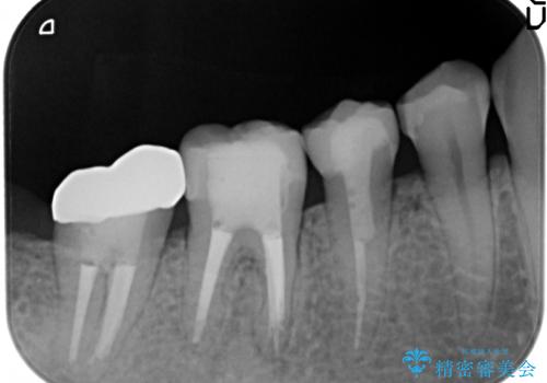 歯冠長延長術を用いた被せものの治療後