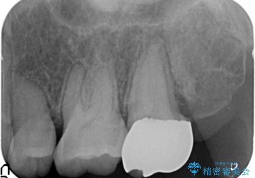 銀歯を白く　セラミッククラウンに　矯正後のやり変えの治療前