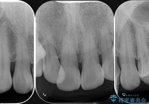 歯周外科手術を用いた歯周ポケットの改善の治療前