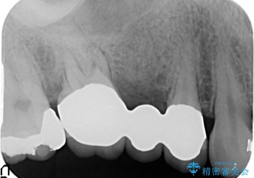 放置した歯の欠損　ブリッジによるスピーディーな咬合機能回復の治療後