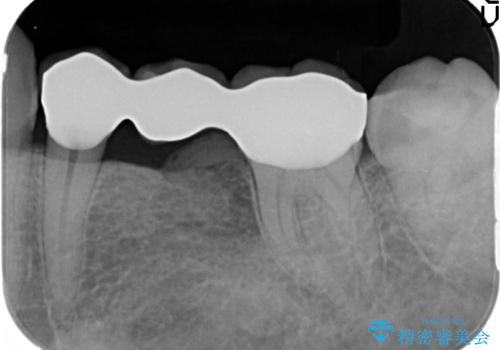 虫歯の元となるインレーブリッジの除去の治療後