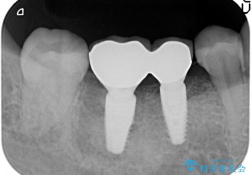 奥歯のインプラント　セラミック修復