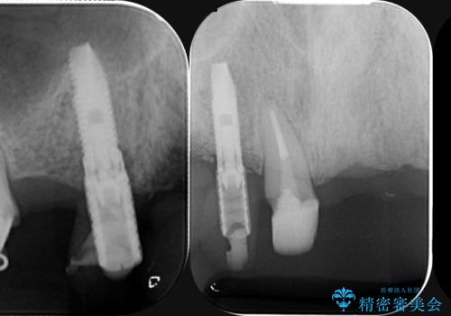 [ 重度虫歯治療 ]　ブリッジ・インプラントによる咬合・審美回復①の治療後