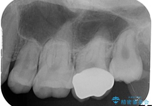奥歯で広がった虫歯、中途半端な仮詰め状態をセラミッククラウンで解消するの治療後