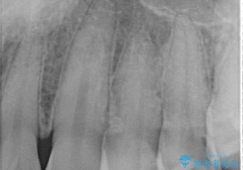 歯と歯の間の虫歯をセラミックインレーで修復の治療前