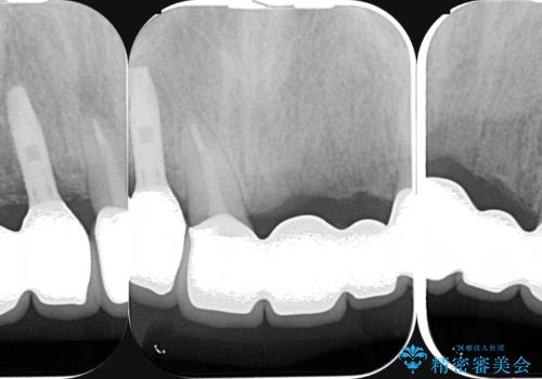 [ 重度虫歯治療 ]　ブリッジ・インプラントによる咬合・審美回復②の治療後