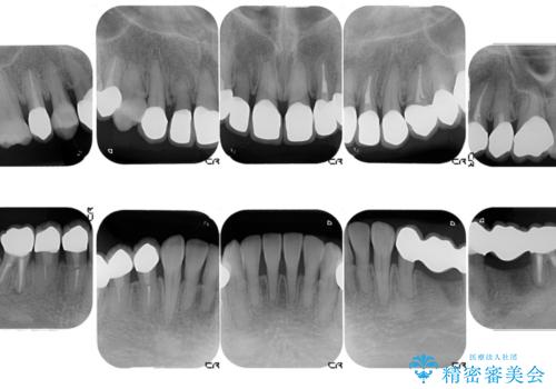 金属を白いものにして、悪いところを治したい　矯正治療も含めた総合歯科治療の治療後