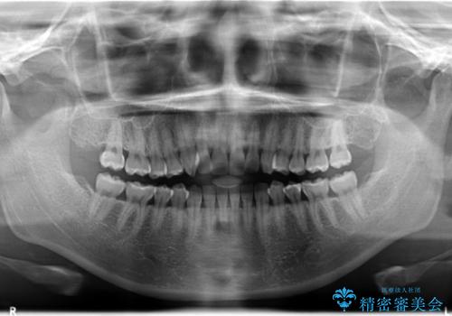 前歯のクロスバイトをインビザラインとマイクロインプラントのコンビネーションで短期間に治すの治療前