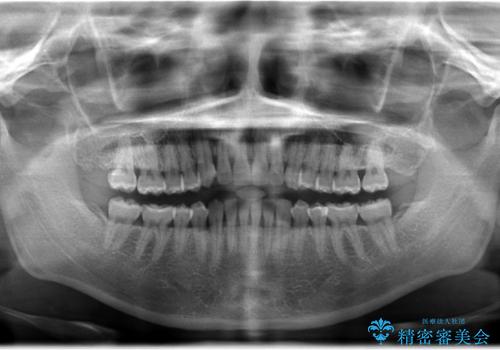前歯のクロスバイトをインビザラインとマイクロインプラントのコンビネーションで短期間に治すの治療後